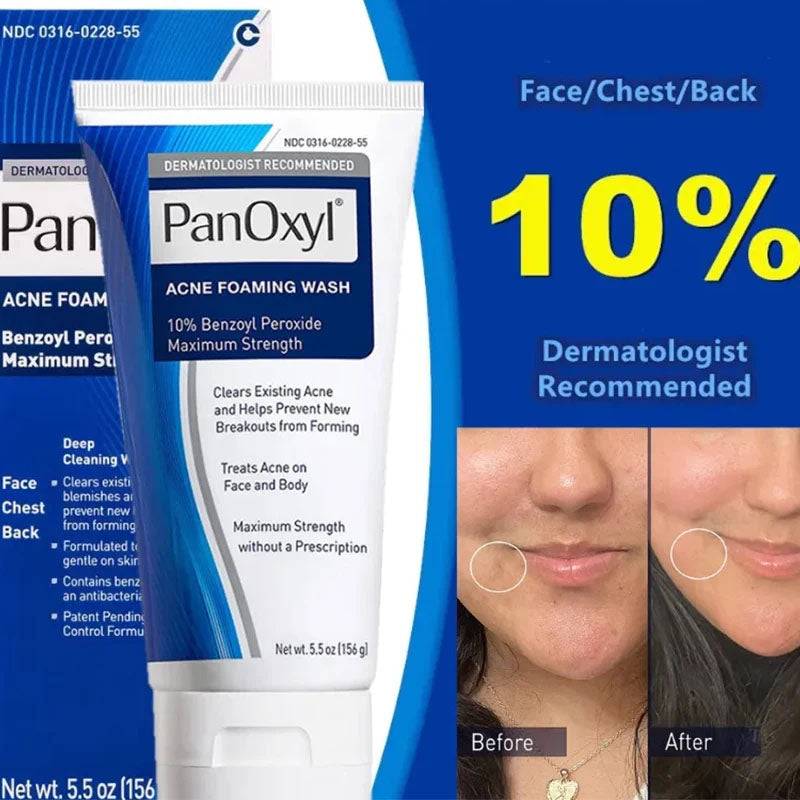PanOxyl Acne Foaming Wash 10% Benzoyl Peroxide – Maximum Strength for Clear Skin (5.5 oz)