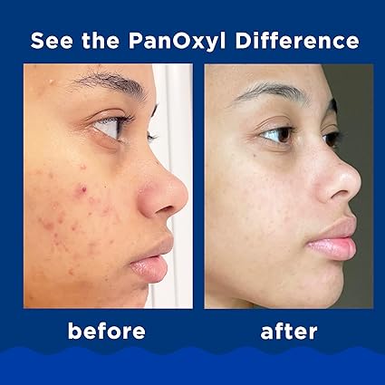 PanOxyl Acne Foaming Wash 10% Benzoyl Peroxide – Maximum Strength for Clear Skin (5.5 oz)